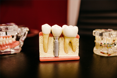implanty zębów Szczecin